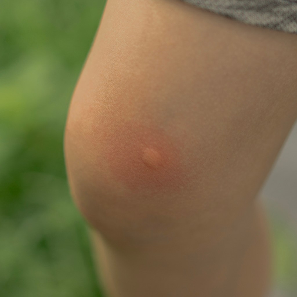 全卉複方精油幫助舒緩蟲咬